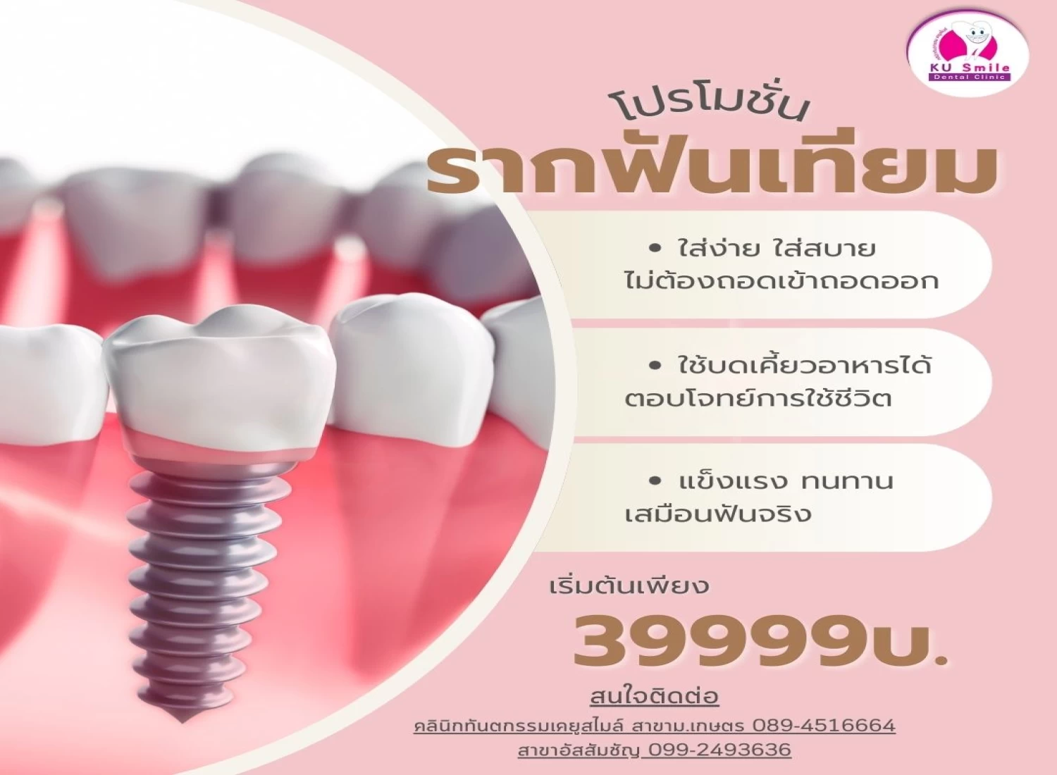 รากเทียม (Implant)