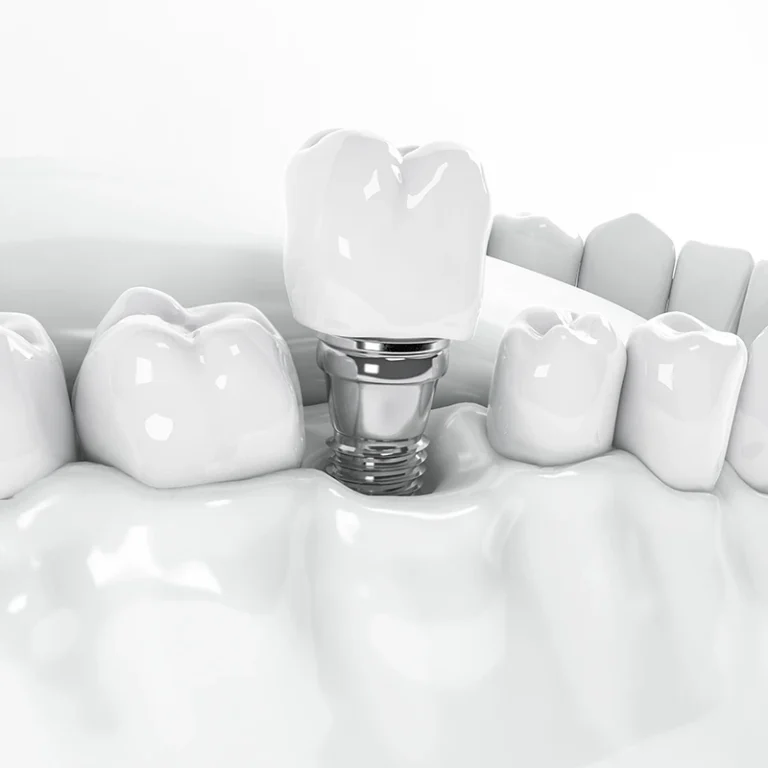 รากฟันเทียม (Dental Implant)
