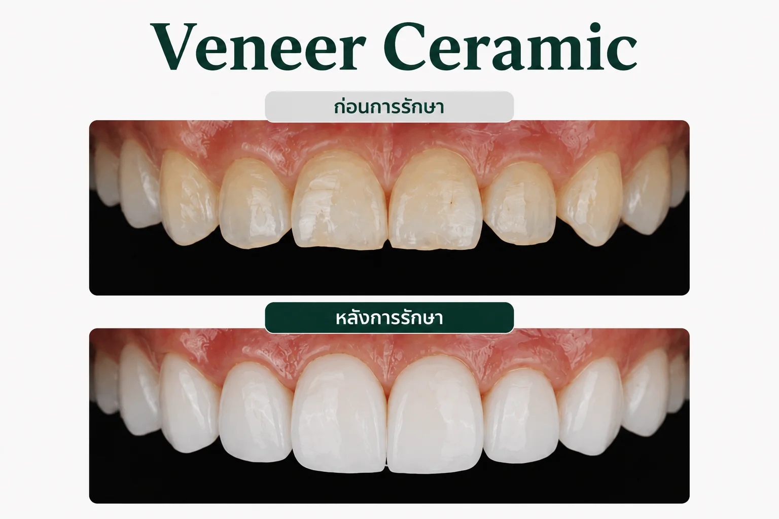 ครอบฟัน และวีเนียร์ชลบุรี (Dental Crowns & Veneers)