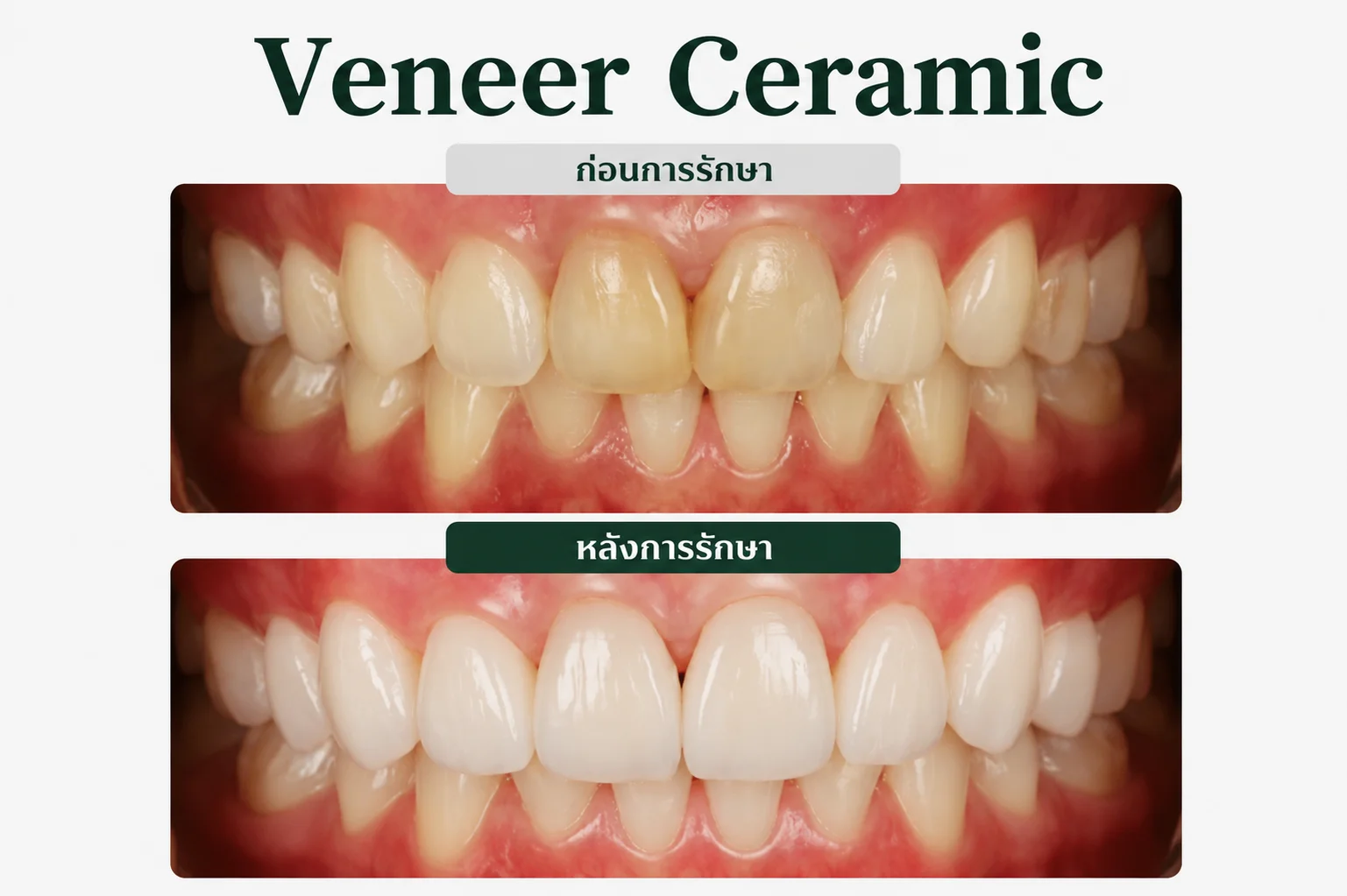 ครอบฟัน และวีเนียร์ชลบุรี (Dental Crowns & Veneers)