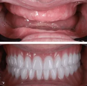 ฟันปลอมถอดได้ (Removable Denture)