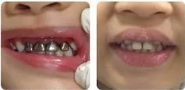 ทันตกรรมสำหรับเด็ก (Pediatric Dentistry)