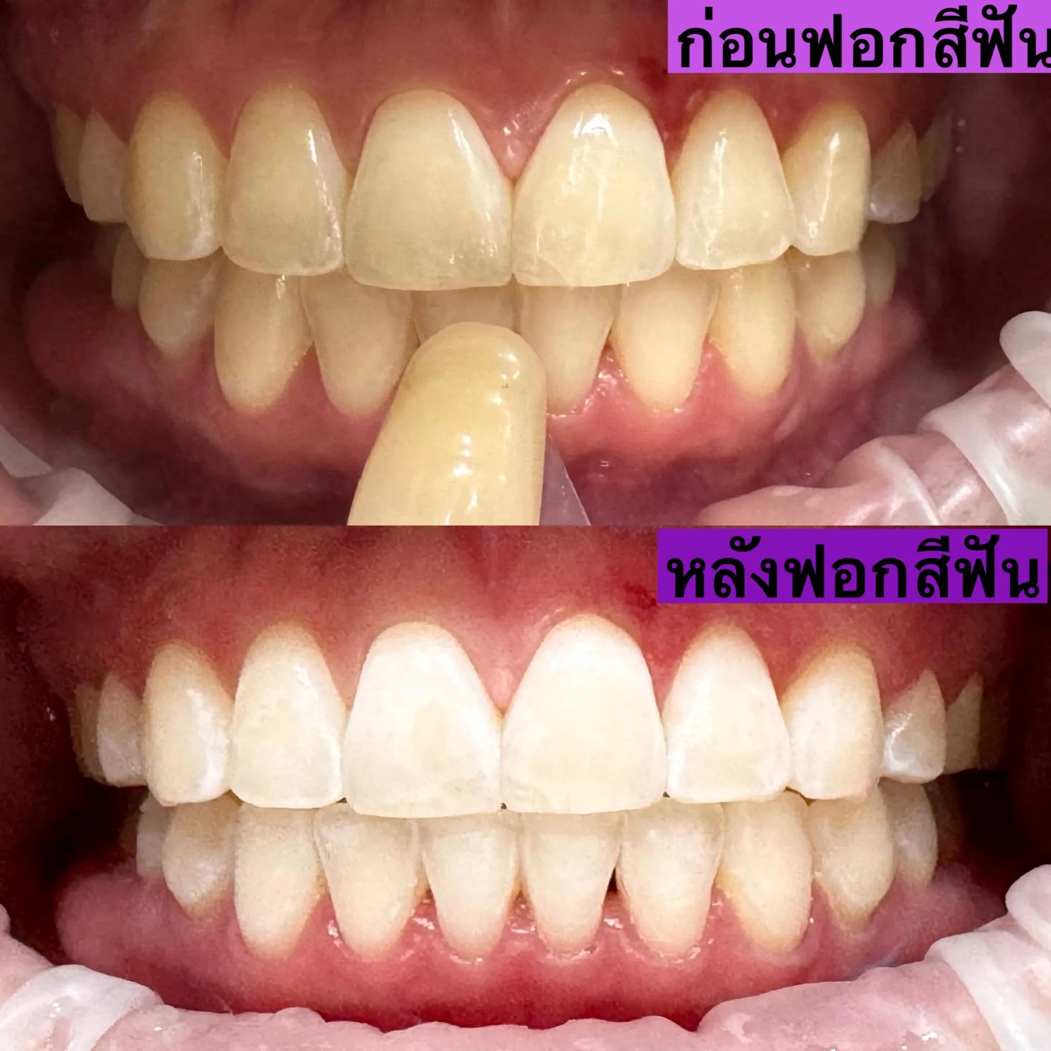 KU Smile Dental Clinic ฟอกสีฟัน ชลบุรี (Tooth Whitening)