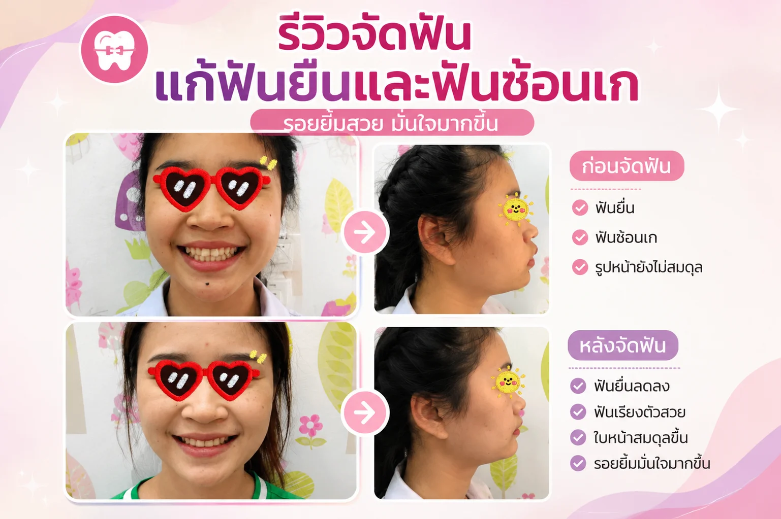 ทันตกรรมจัดฟัน (Orthodontics)