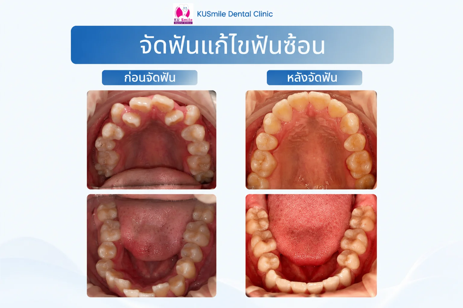 ทันตกรรมจัดฟัน (Orthodontics)