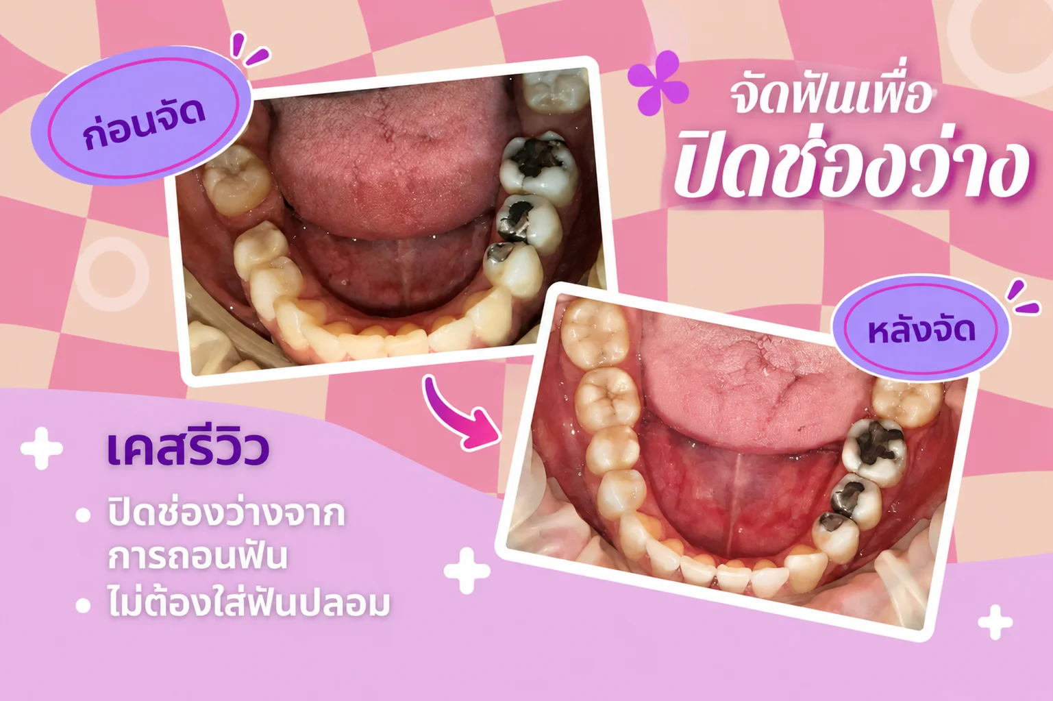 ทันตกรรมจัดฟัน (Orthodontics)