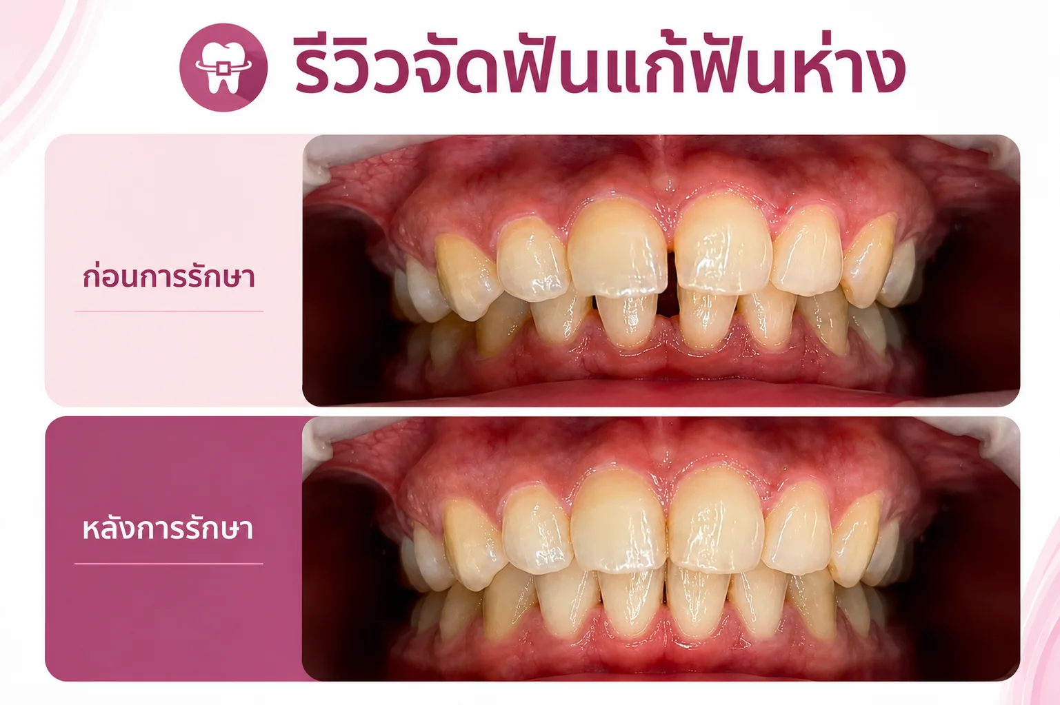 ทันตกรรมจัดฟัน (Orthodontics)