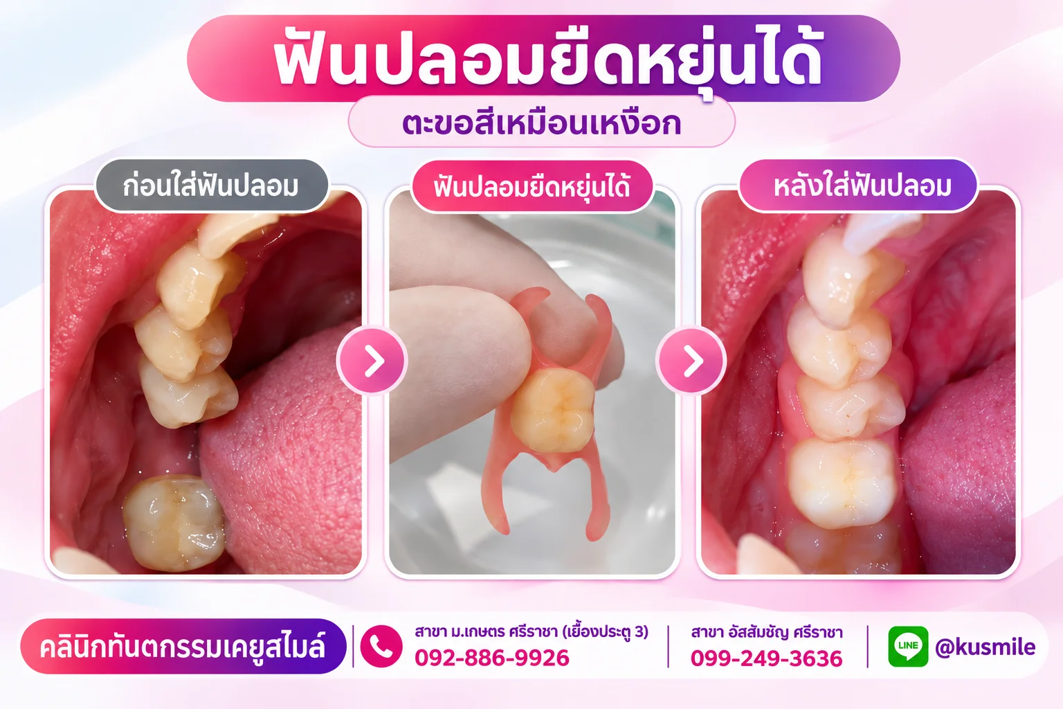 ฟันปลอมถอดได้ (Removable Denture)