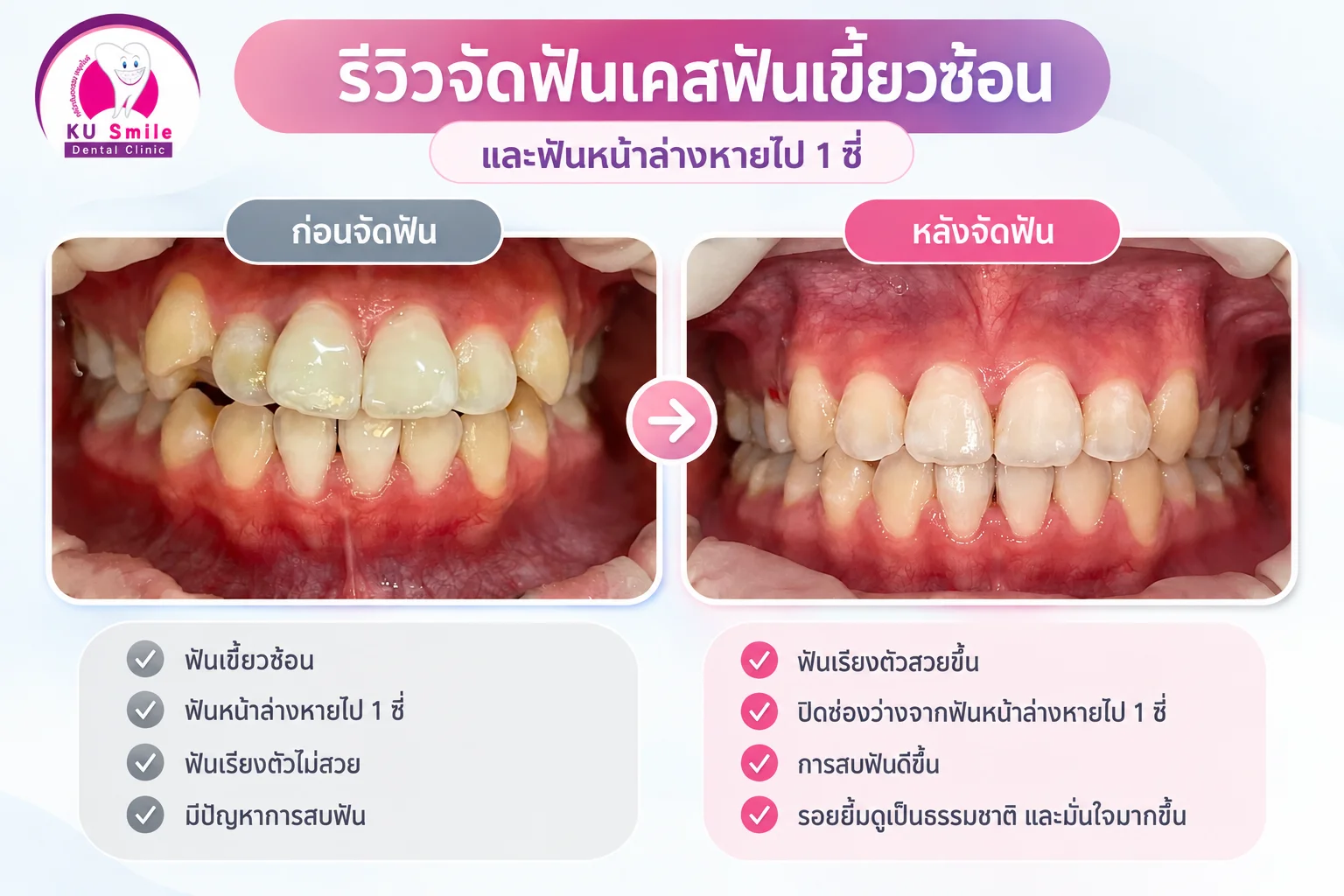 ทันตกรรมจัดฟัน (Orthodontics)