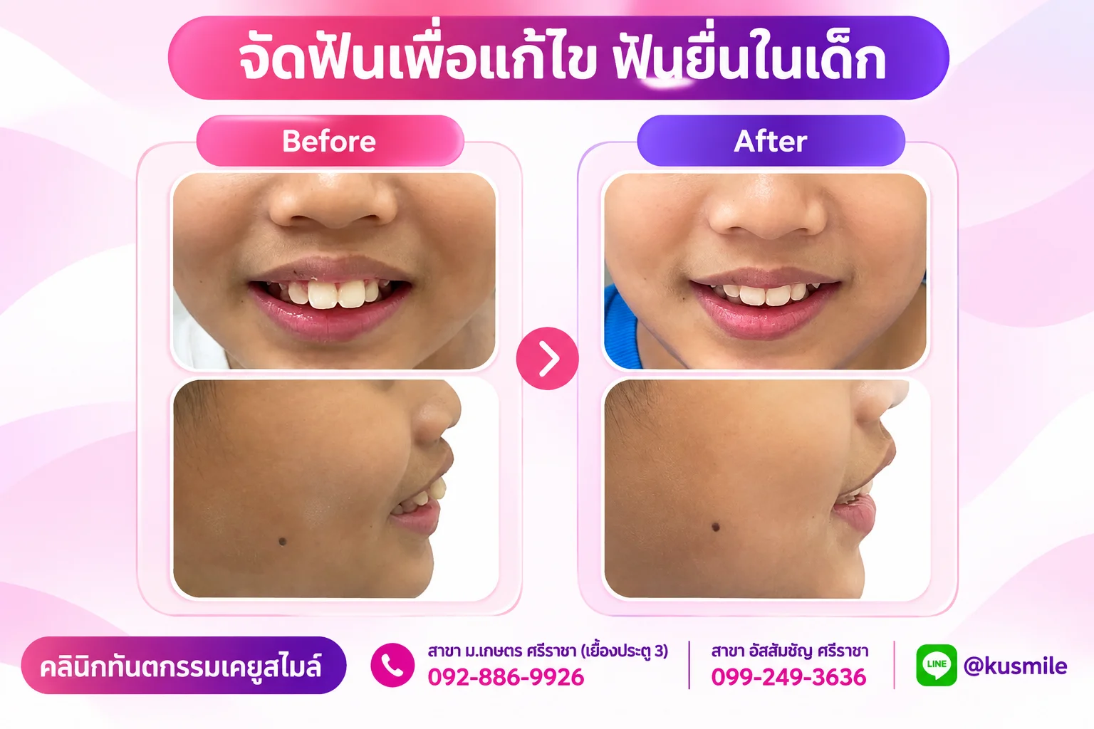 ทันตกรรมจัดฟัน (Orthodontics)