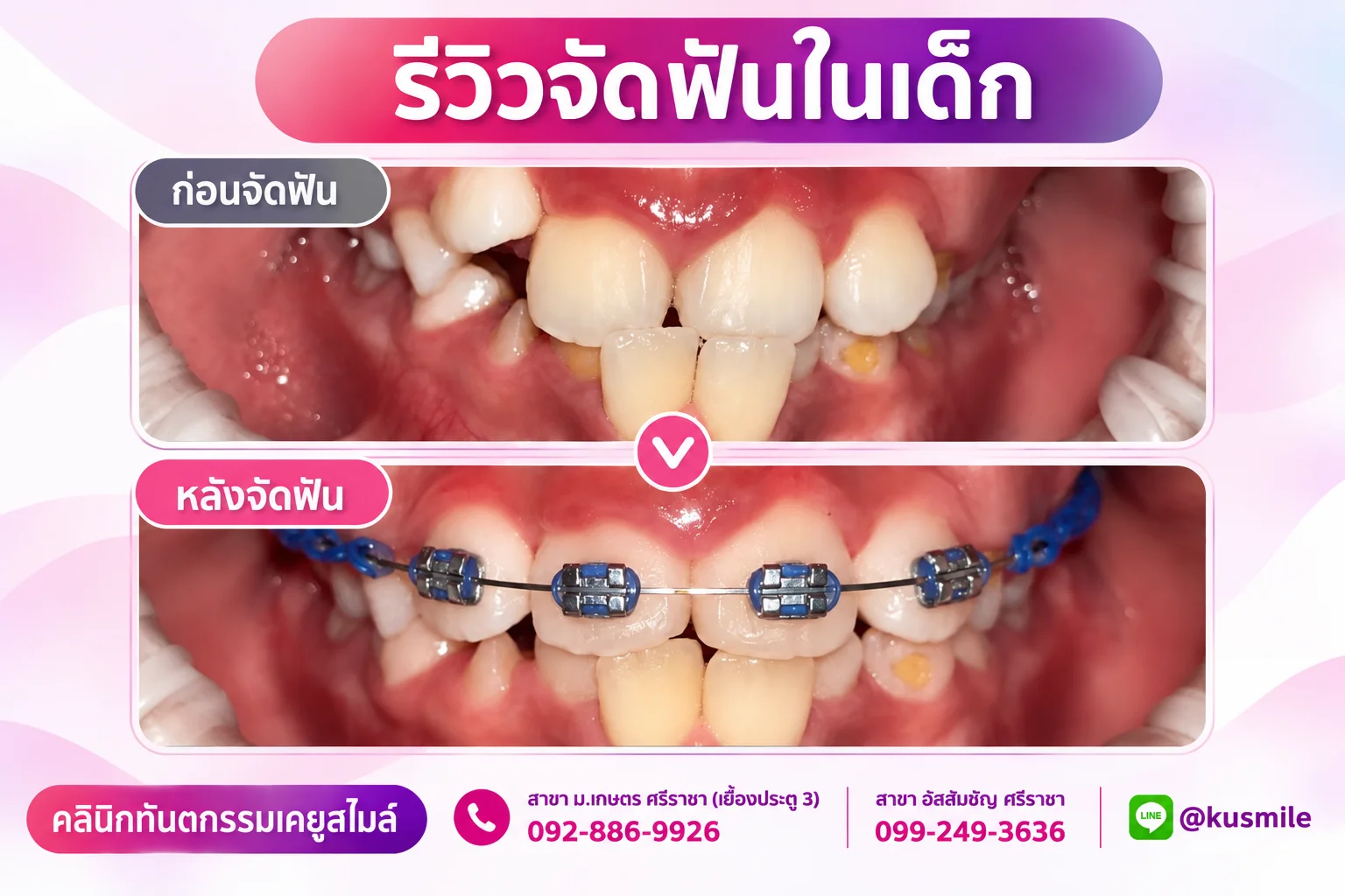 ทันตกรรมจัดฟัน (Orthodontics)