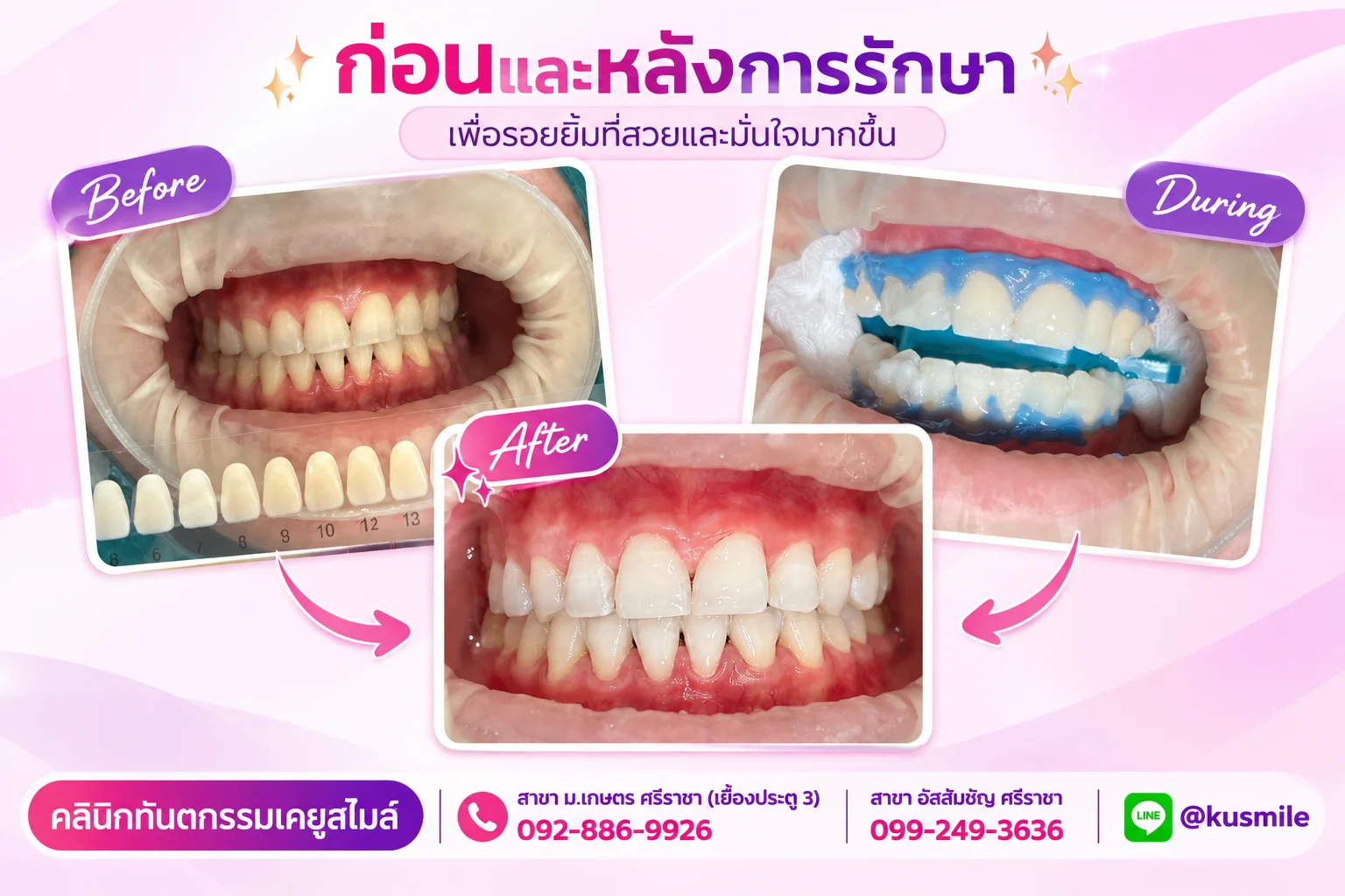 KU Smile Dental Clinic ฟอกสีฟัน ชลบุรี (Tooth Whitening)