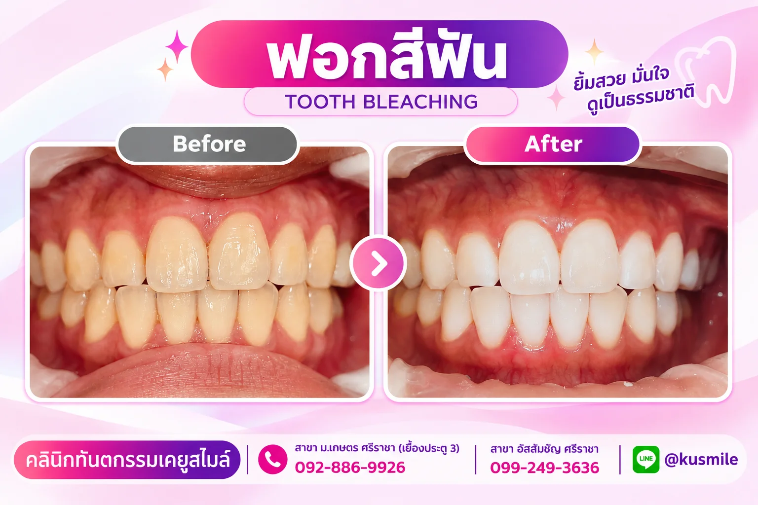 KU Smile Dental Clinic ฟอกสีฟัน ชลบุรี (Tooth Whitening)