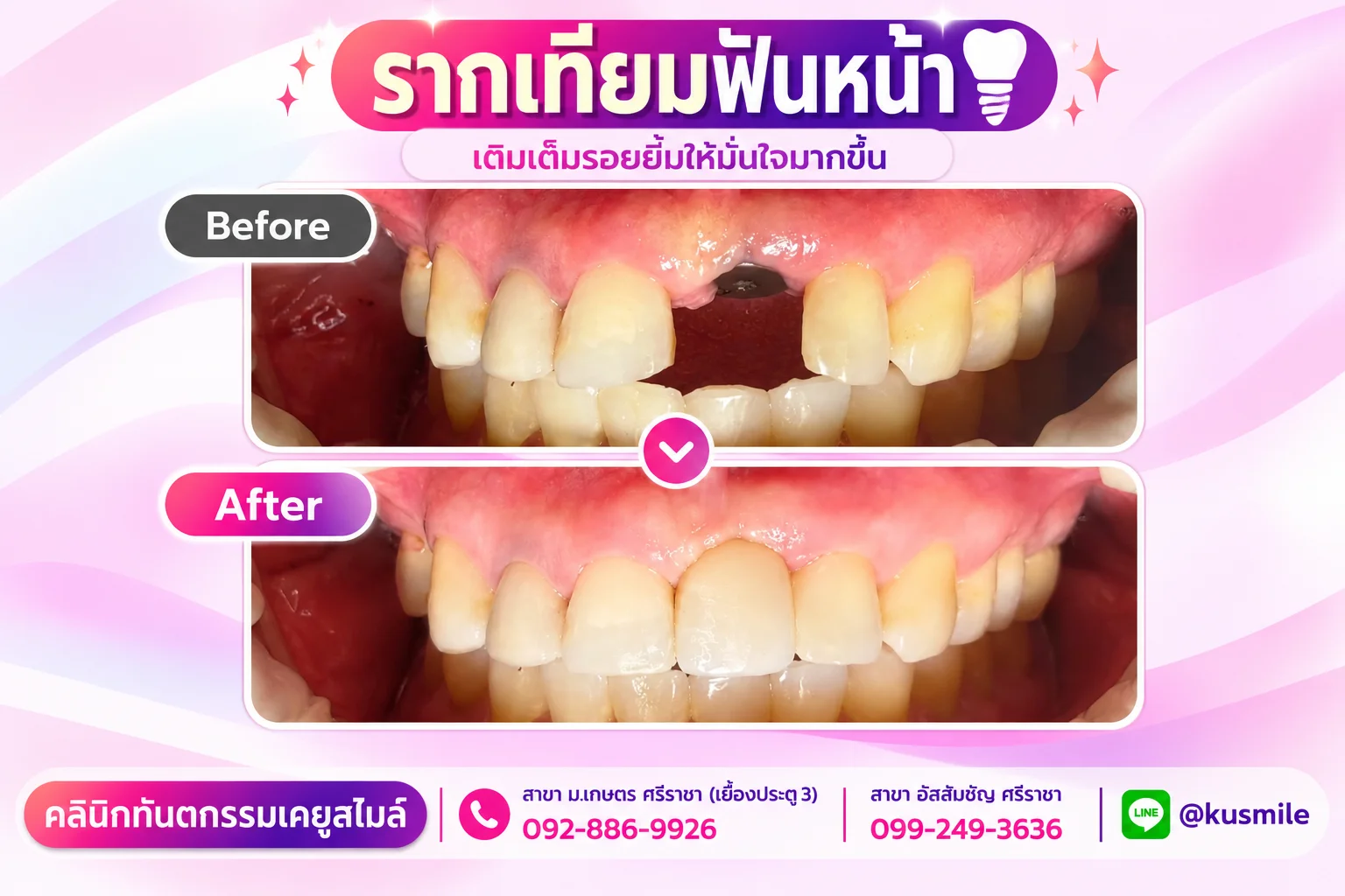 รากฟันเทียม (Dental Implant)