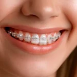 จัดฟันมีกี่แบบ? เปรียบเทียบข้อดี ข้อเสีย และการเลือกแบบจัดฟัน